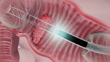 DiLumen Animation (minimally-invasive surgery)