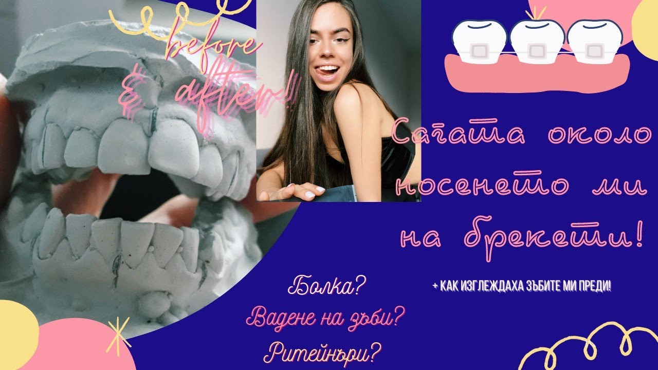 Сагата около носенето ми на БРЕКЕТИ! (+ как изглеждаха зъбите ми преди)