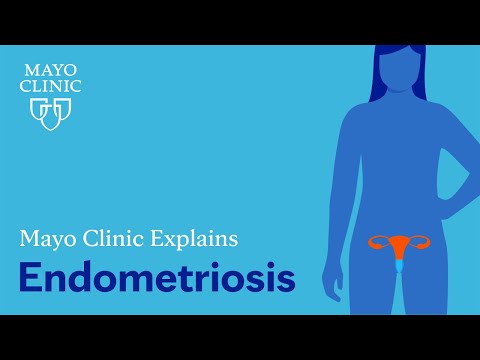 Poliklinika Harni - Rizični čimbenici za nastanak endometrioze