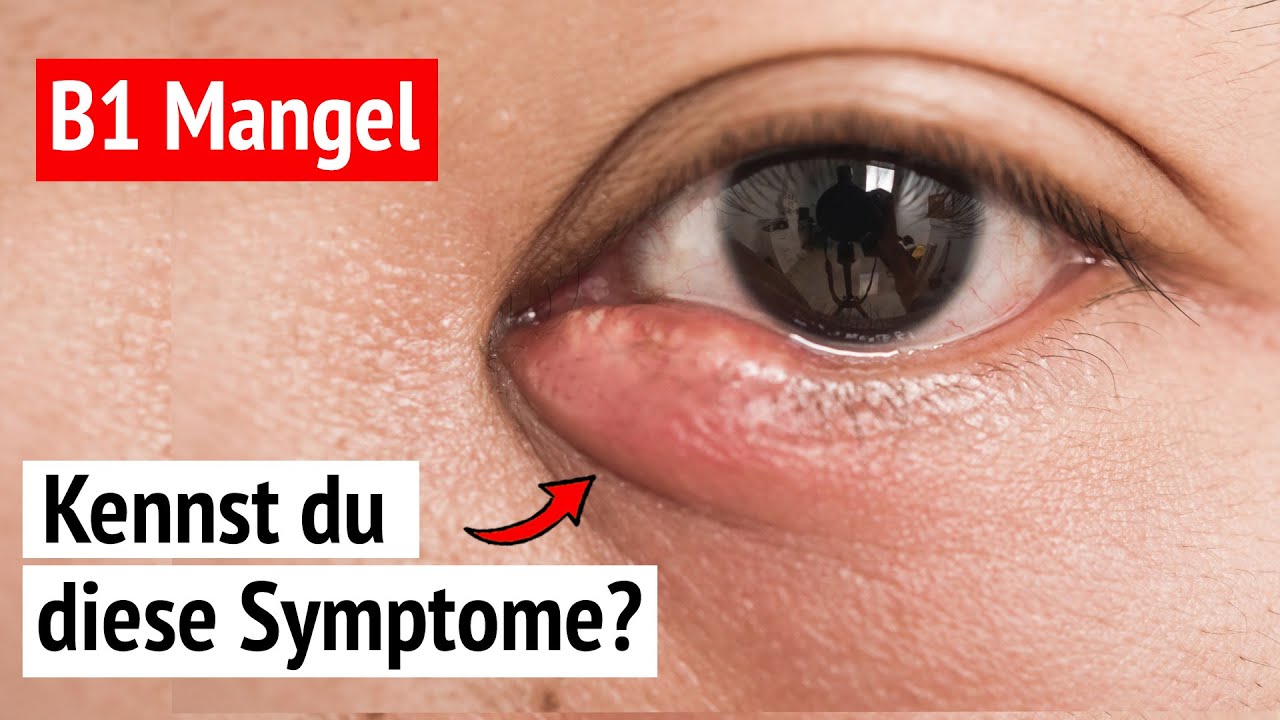 😱 B1 Mangel: Diese 5 Symptome gefährden deine Gesundheit - YouTube