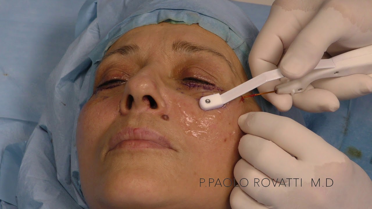 ACCUTITE MALAR BAG MUTE YouTube