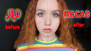 Как избавиться от прыщей с помощью магии в домашних условиях за 1 день \ Acne magic Как избавиться от прыщей с помощью магии в домашних условиях за 1 день \ Acne magic