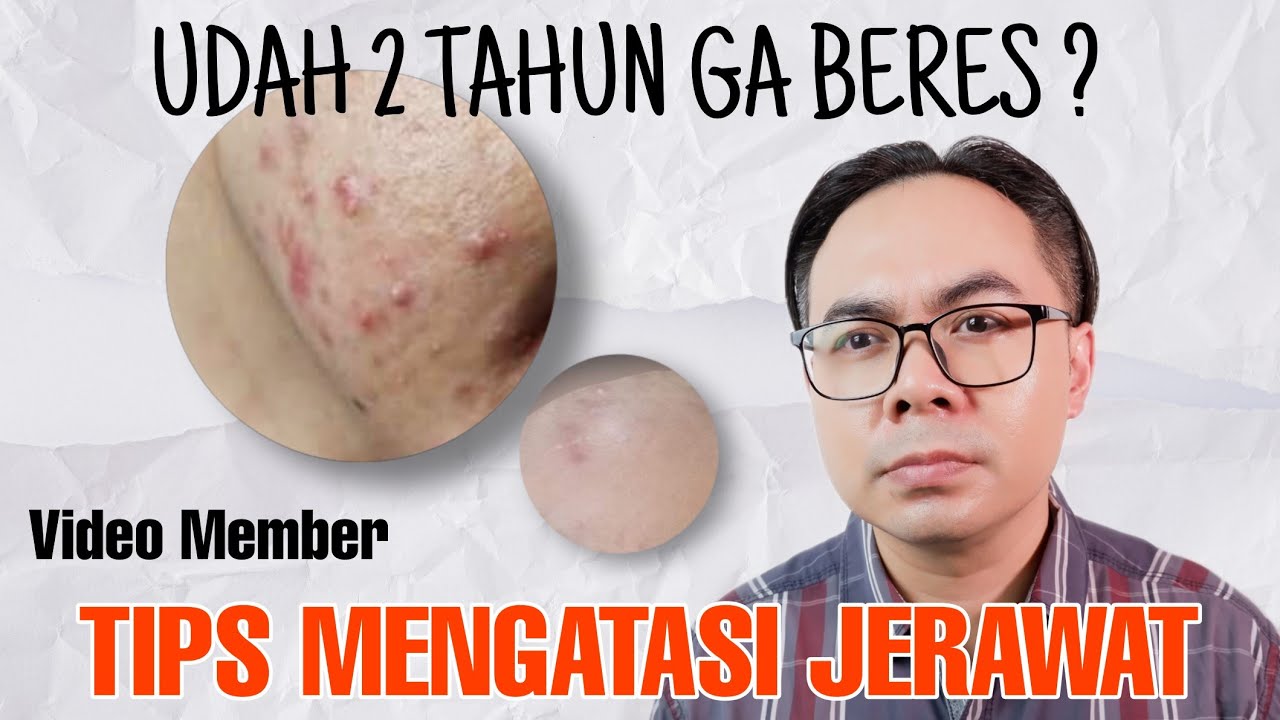 CARA MENGATASI JERAWAT AKUT MENAHUN 