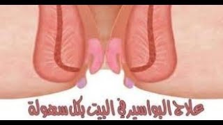 خطير.. علاج البواسير  ، في ثلاث ايام فقط II 2017