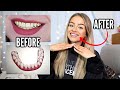 HOW I FIXED MY TEETH.. INVISALIGN EXPERIENCE - PROS, CONS, PRICE etc