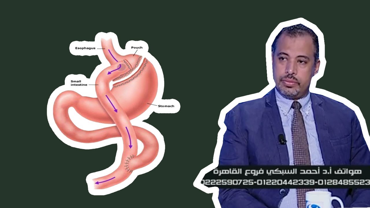 خسارة 62 كيلو خلال 7 شهور من عملية تحويل مسار المعدة بالمنظار مع دكتور احمد السبكي