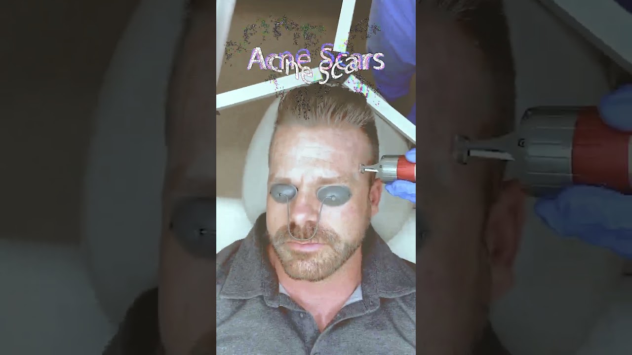 We Treated Him With the Erbium Laser for his Wrinkles, Brown Spots, and more!