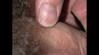 How To Remove Genital Warts Wart Mole Vanish