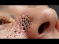 #PoreZen #BlackheadRemoval #PimplePopping #ASMRBlackhead 74