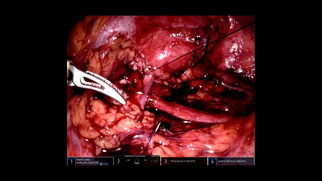 Robot-assisted left dismembered pyeloplasty