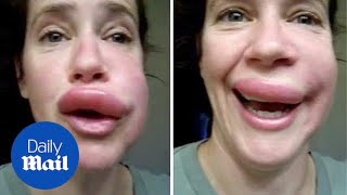 Sengatan tawon di bibir wanita menyebabkan pembengkakan besar - Daily Mail