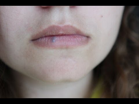 Vidéo: Cancer Des Lèvres - Symptômes, Traitement