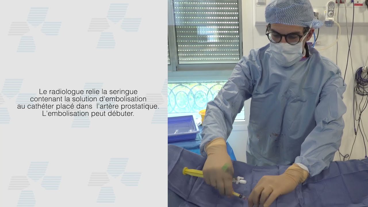 L'embolisation de la prostate