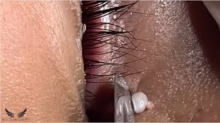 Big Eye Pimple Removal - Chalazion Excision - Satisfy Blackheads Extraction - Acne Beauty Spa | #008