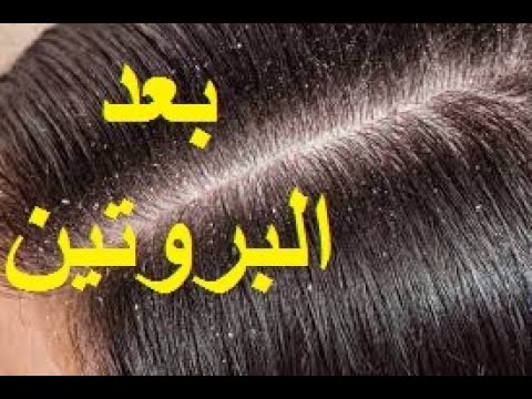 اسباب القشرة في الشعر بعد استعمال البروتين و كيفية إزالتها بسهولة - YouTube