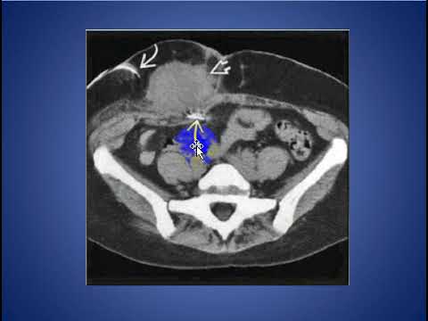 ABDOMINAL WALL MASS