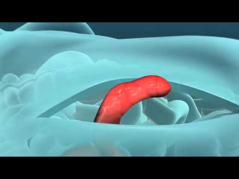 How An Appendix Is Removed Youtube