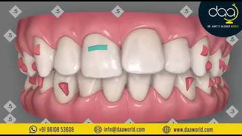 Invisible 𝐈𝐧𝐯𝐢𝐬𝐚𝐥𝐢𝐠𝐧 technology | Invisalign | Smile | Aligners