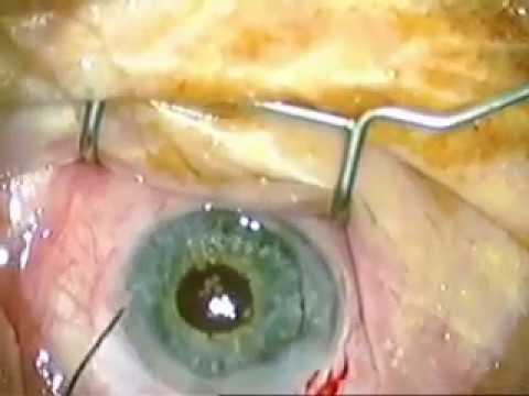 ARTIFICIALIRIS: iris implantation with pseudophakia