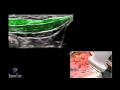 3D How To: Ultrasound Guided Tap Block - SonoSite Ultrasound