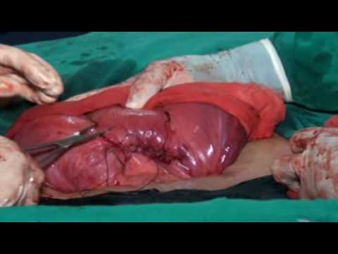 New Technique "B-Lynch Sutures" for Cesarean Operation