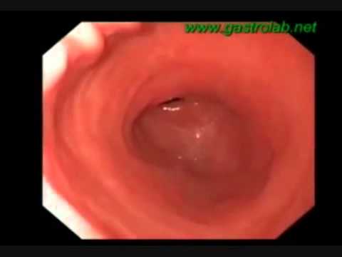 Peristalsis in Action - YouTube