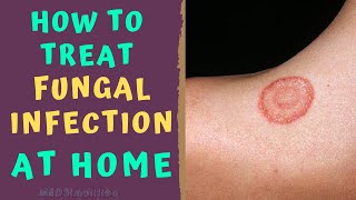 HOW TO TREAT SKIN FUNGAL INFECTION INFECTION AT HOME   TINEA RINGWORM REMEDIES HOW TO CURE screenshot 5