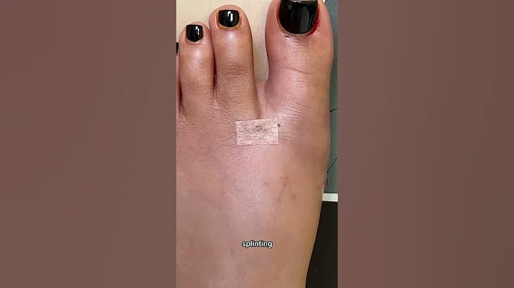 CONSIDERING MINIMALLY INVASIVE BUNION SURGERY? IF SO, LISTEN UP!👨🏻‍⚕️#shorts #bunions #bunion