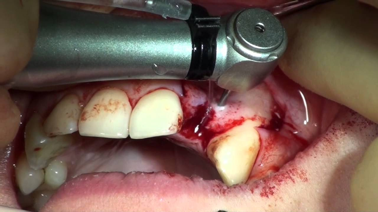 Alveolar Ridge Augmentation