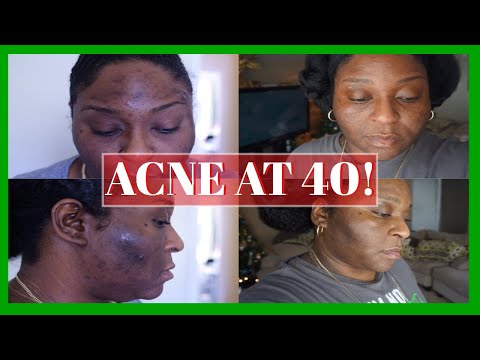 who-the-hell-still-gets-acne-at-40?!-|-my-skin-care-products!