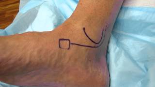 Posterior Tibial Tendon Dysfunction Timonium Foot and Ankle Center, Pre-Treatment Physical Exam