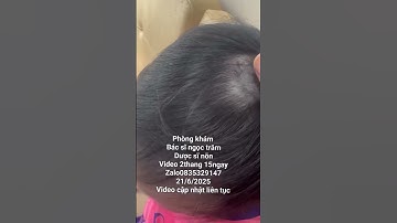 rụng tóc mảng. bé huyền hà nội. video 2 tháng 15 ngày #toctoc