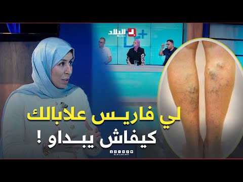 علابالك كيفاش يبانو ليفاريس وواش يصرى حتى يولي مرض شوف الفيديو