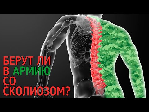 Сколиоз и армия | С каким сколиозом не берут в армию?