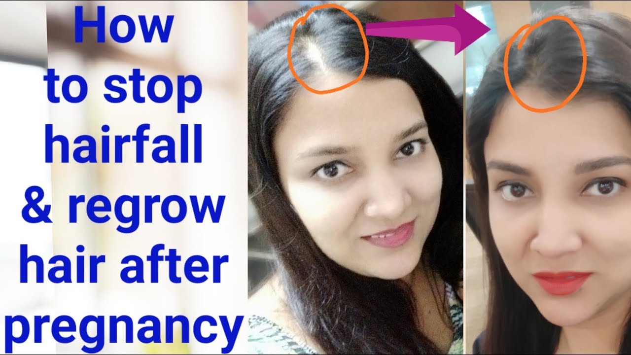 How to stop hairfall after pregnancy YouTube