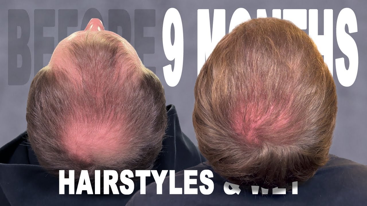 9 MONTHS | HAIR TRANSPLANT | COSMEDICA CLINIC