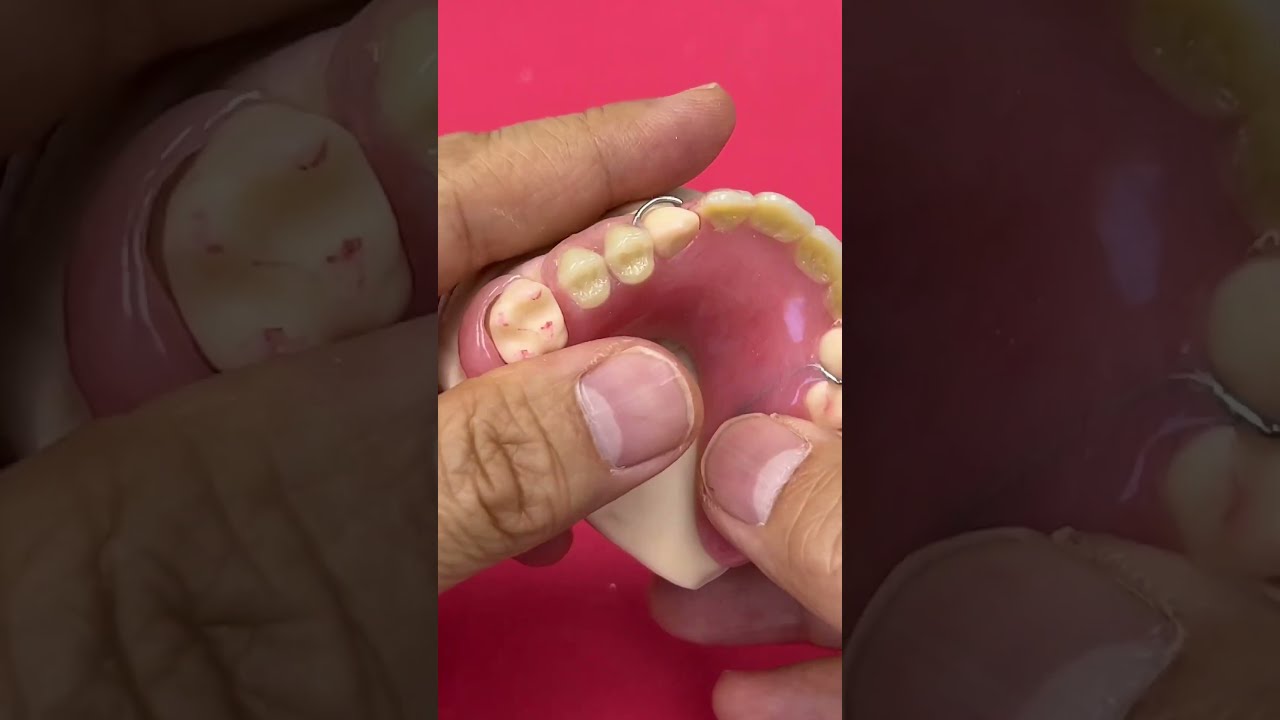 Upper And Lower Partials With Metal Wire Clasps