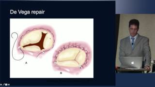 Concepts in Tricuspid Valve Disease