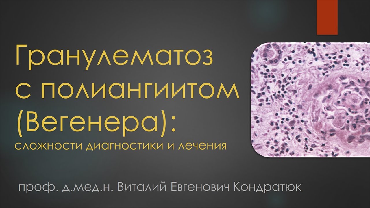 Гранулематоз с полиангиитом (Вегенера): сложности диагностики и лечения ...