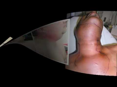 ludwig s angina