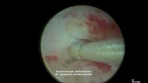 Hysteroscopic adhesiolysis