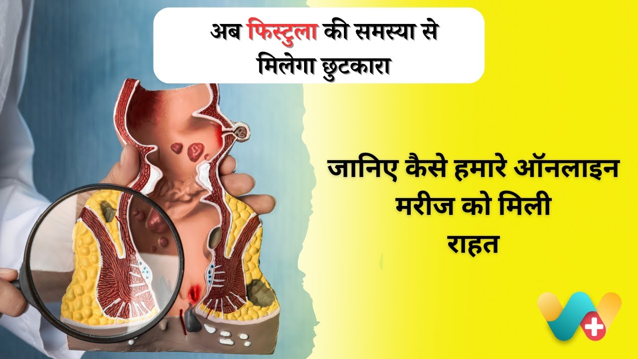 Fistula ka homeopathy Ilaj Akhilesh Ji ki Success Story YouTube