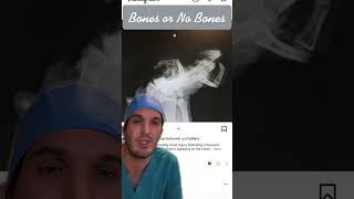 Fireworks trauma 🧨 #medicine #doctor #medschool #xray #fireworks