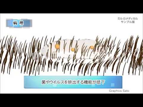 気管支拡張症／2分で分かる医療動画辞典　ミルメディカル