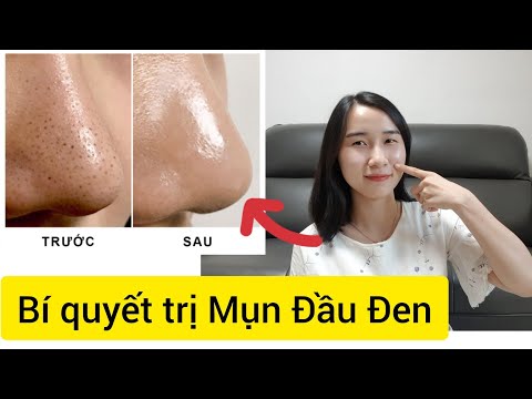 Cách Trị Mụn Đầu Đen Hiệu Quả  100% tại nhà