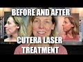 BEFORE & AFTER CUTERA LASER | GENESIS FACIAL- CELEBRITY FACIAL!