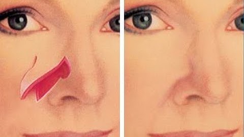 Adjacent tissue transfer CPT code - simplify medical coding