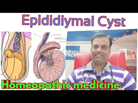 EPIDIDYMAL CYST- Cause , Symptom , Homeopathic Medicine - YouTube