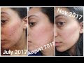 Accu tane 4.5 months and updated skincare UK