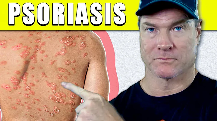 8 Ways to Improve Psoriasis FAST